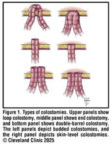 What do Gastroenterologists Need to Know About Stomas? - Practical Gastro