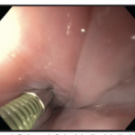 efficacy and safety of peroral endoscopic myotomy for the treatment of achalasia: a systematic review. J Cardiothorac Surg. 2019;14(1):1. Published 2019 Jan 3. doi:10.1186/ s13019-018-0811-9 52 Rodríguez de Santiago E, Mohammed N, Manolakis A, Shimamura Y, Onimaru M, Inoue H. Anterior versus posterior myotomy during poem for the treatment of achalasia: systematic review and meta-analysis of randomized clinical trials. J Gastrointestin Liver Dis. 2019;28(1):107-115. doi:10.15403/jgld.2014.1121.281.pom 53 Vespa E, Barchi A, Mandarino FV, et al. Standard length of peroral endoscopic myotomy (POEM) for achalasia: a systematic review and meta-analysis. Dis Esophagus. 2024;37(12):doae069. doi:10.1093/dote/doae069 54 Zhang H, Zeng X, Huang S, et al. Mid-Term and Long- Term Outcomes of Peroral Endoscopic Myotomy for the Treatment of Achalasia: A Systematic Review and Meta- Analysis. Dig Dis Sci. 2023;68(4):1386-1396. doi:10.1007/ s10620-022-07720-4 55 Zhong C, Tan S, Ren Y, et al. Quality of Life Following Peroral Endoscopic Myotomy for Esophageal Achalasia: A Systematic Review and Meta-Analysis. Ann Thorac Cardiovasc Surg. 2020;26(3):113-124. doi:10.5761/atcs. ra.19-00273 56 Shou Y, Wang X, Liu D. Factors associated with peroral endoscopic myotomy for achalasia outcomes: systematic review and meta-analysis. Surg Endosc. 2024;38(7):3503- 3519. doi:10.1007/s00464-024-10862-3 57 Andolfi C, Fisichella PM. Meta-analysis of clinical outcome after treatment for achalasia based on manometric subtypes. Br J Surg. 2019;106(4):332-341. doi:10.1002/ bjs.11049 58 Hayat U, Kamal F, Memon A, et al. Peroral Endoscopic Myotomy for Achalasia Among the Elderly Population: A Systematic Review and Meta-Analysis. J Clin Gastroenterol. Published online February 10, 2025. doi:10.1097/ MCG.0000000000002103 59 Hayat U, Kamal F, Rana UI, et al. Efficacy and Safety of Repeat Per-oral Endoscopic Myotomy After Failed POEM for Achalasia: A Systematic Review and meta-analysis. J Clin Gastroenterol. Published online December 5, 2024. doi:10.1097/MCG.0000000000002117 60 Mota RCL, de Moura EGH, de Moura DTH, et al. Risk factors for gastroesophageal reflux after POEM for achalasia: a systematic review and meta-analysis. Surg Endosc. 2021;35(1):383-397. doi:10.1007/s00464-020-07412-y 61 Dhoop S, Abu-Rumaileh M, Sayeh W, et al. Efficacy and safety of full-thickness versus circular peroral endoscopic myotomy for treatment of achalasia: a systematic review and meta-analysis. Ann Gastroenterol. 2025;38(2):143-155. doi:10.20524/aog.2025.0946 62 Mohan BP, Ofosu A, Chandan S, et al. Anterior versus posterior approach in peroral endoscopic myotomy (POEM): a systematic review and meta-analysis. Endoscopy. 2020;52(4):251-258. doi:10.1055/a-1090-0788 63 Zhang H, Zeng X, Huang S, et al. Safety and Efficacy of Peroral Endoscopic Shorter Myotomy versus Longer Myotomy for Patients with Achalasia: A Systematic Review and Metaanalysis. Gastroenterol Res Pract. 2022;2022:6770864. Published 2022 Mar 30. doi:10.1155/2022/6770864 64 Weng CY, He CH, Zhuang MY, Xu JL, Lyu B. Peroral endoscopic longer vs shorter esophageal myotomy for achalasia treatment: A systematic review and meta-analysis. World J Gastrointest Surg. 2022;14(3):247-259. doi:10.4240/wjgs. v14.i3.247 65 Ghazaleh S, Beran A, Khader Y, et al. Short versus standard peroral endoscopic myotomy for esophageal achalasia: a systematic review and meta-analysis. Ann Gastroenterol. 2021;34(5):634-642. doi:10.20524/aog.2021.0644 66 Tan S, Zhong C, Ren Y, et al. Efficacy and Safety of Peroral Endoscopic Myotomy in Achalasia Patients with Failed Previous Intervention: A Systematic Review and Meta- Analysis. Gut Liver. 2021;15(2):153-167. doi:10.5009/ gnl19234 67 Zhong C, Ni B, Liu S, et al. The Effect of Peroral Endoscopic Myotomy in Achalasia Patients with Prior Endoscopic Intervention: A Systematic Review and Meta-Analysis. Dig Surg. 2021;38(2):136-148. doi:10.1159/000512627 68 Vespa E, Pellegatta G, Chandrasekar VT, et al. Longterm outcomes of peroral endoscopic myotomy for achalasia: a systematic review and meta-analysis. Endoscopy. 2023;55(2):167-175. doi:10.1055/a-1894-0147 69 Patel K, Abbassi-Ghadi N, Markar S, Kumar S, Jethwa P, Zaninotto G. Peroral endoscopic myotomy for the treatment of esophageal achalasia: systematic review and pooled analysis. Dis Esophagus. 2016;29(7):807-819. doi:10.1111/ dote.12387 70 Mota RCL, de Moura EGH, de Moura DTH, et al. Risk factors for gastroesophageal reflux after POEM for achalasia: a systematic review and meta-analysis. Surg Endosc. 2021;35(1):383-397. doi:10.1007/s00464-020-07412-y 71 Gopakumar H, Annor E, Vohra I, et al. Peroral endoscopic myotomy with fundoplication (POEM-F) for achalasia: Systematic review and meta-analysis [published correction appears in Endosc Int Open. 2025 Mar 19;13:a25624787. doi: 10.1055/a-2562-4787.]. Endosc Int Open. 2025;13:a25368132. Published 2025 Mar 14. doi:10.1055/a-2536-8132